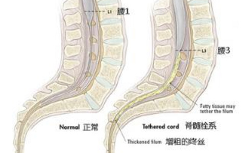 脊髓栓系综合征的症状全解析